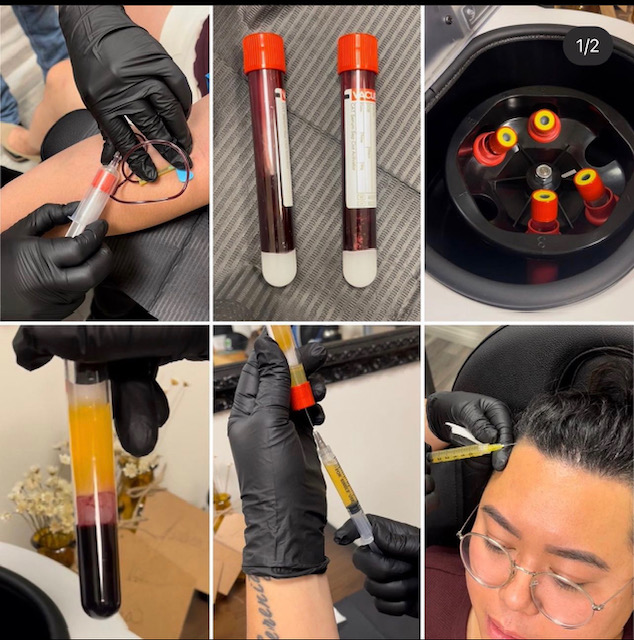 platelet-rich plasma